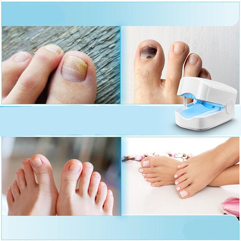 Nail Fungus Cleaning Laser Device - Expert Revolutionary High-Efficiency Light Therapy Device For Toenail Diseases